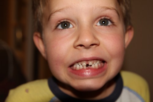 The other bottom tooth is ready.......